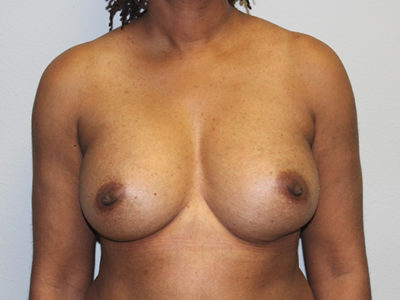 Breast Explant