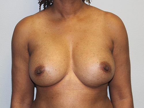 Before and after plastic surgery results in Dallas, TX, performed by Dr. Surjit Rai, MD.