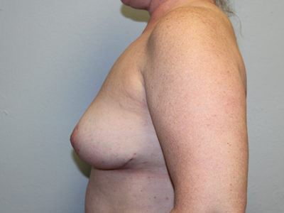 Breast Explant with Lift or Reduction