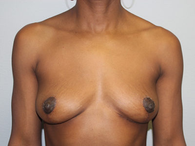 Before & After Photos: Breast Explant with Lift or Reduction
