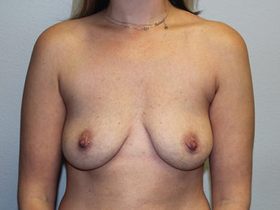 Breast Explant