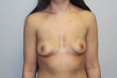 Before & After Photos Breast Explant