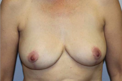 Breast Explant with Lift or Reduction