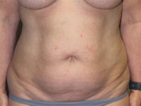 Before & After Photos: Breast Explant With Other Cosmetic Procedures