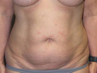 Breast Explant With Other Cosmetic Procedures