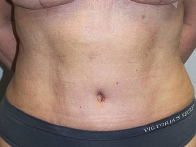 Before & After Photos: Breast Explant With Other Cosmetic Procedures