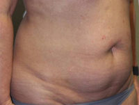 Before & After Photos: Breast Explant With Other Cosmetic Procedures