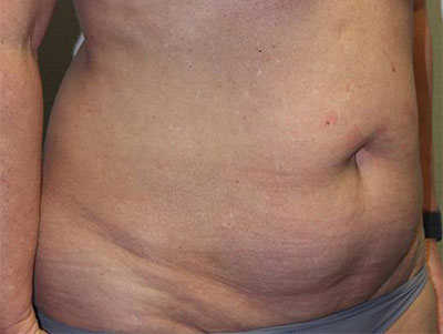 Before & After Photos: Breast Explant With Other Cosmetic Procedures