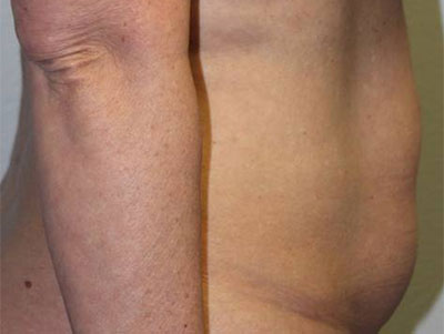 Before & After Photos: Breast Explant With Other Cosmetic Procedures