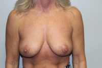 Before & After Photos: Breast Explant with Lift or Reduction