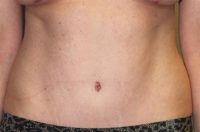 Before & After Photos: Breast Explant With Other Cosmetic Procedures