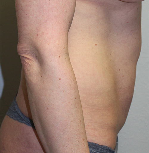 Before and after plastic surgery results in Dallas, TX, performed by Dr. Surjit Rai, MD.