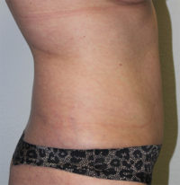 Before & After Photos: Breast Explant With Other Cosmetic Procedures