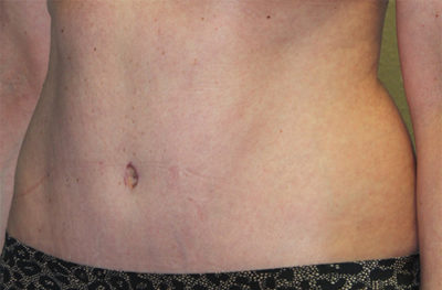 Before & After Photos: Breast Explant With Other Cosmetic Procedures