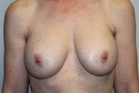 Breast Explant with Lift or Reduction