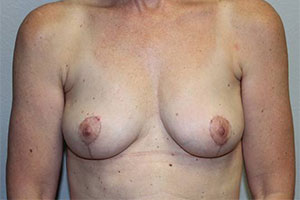 Before & After Photos: Breast Explant with Lift or Reduction