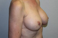 Breast Explant with Lift or Reduction