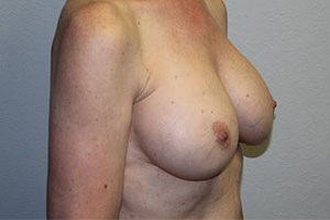 Before & After Photos: Breast Explant with Lift or Reduction