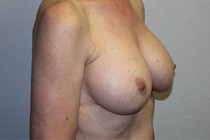 Breast Explant with Lift or Reduction