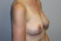 Breast Explant with Lift or Reduction