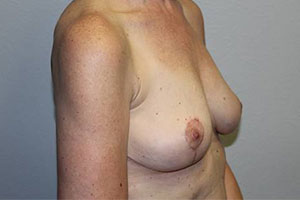 Before & After Photos: Breast Explant with Lift or Reduction