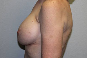 Before & After Photos: Breast Explant with Lift or Reduction