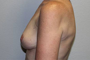 Before & After Photos: Breast Explant with Lift or Reduction
