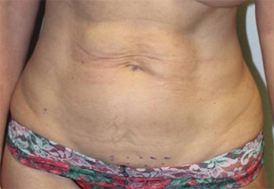 Before & After Photos: Breast Explant With Other Cosmetic Procedures
