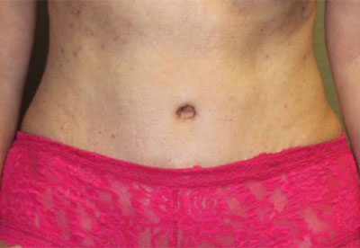 Before & After Photos: Breast Explant With Other Cosmetic Procedures