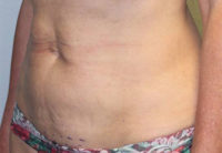 Breast Explant With Other Cosmetic Procedures