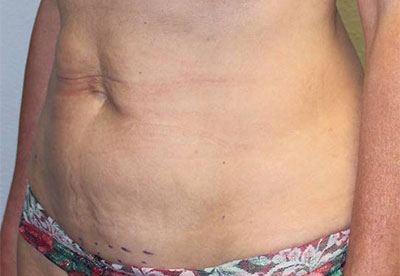 Before & After Photos: Breast Explant With Other Cosmetic Procedures