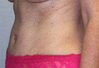 Breast Explant With Other Cosmetic Procedures