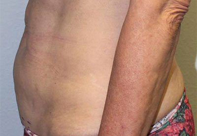 Before & After Photos: Breast Explant With Other Cosmetic Procedures