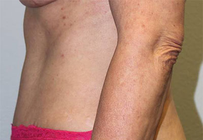 Before & After Photos: Breast Explant With Other Cosmetic Procedures