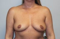 Breast Explant