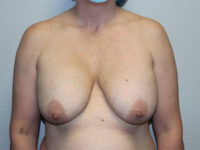 Before & After Photos: Breast Explant with Lift or Reduction