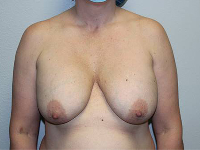 Before & After Photos: Breast Explant with Lift or Reduction