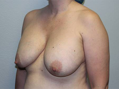 Before & After Photos: Breast Explant with Lift or Reduction