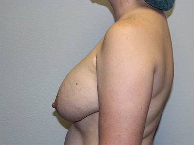 Before & After Photos: Breast Explant with Lift or Reduction