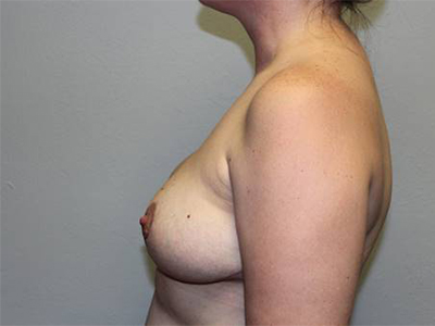 Before & After Photos: Breast Explant with Lift or Reduction