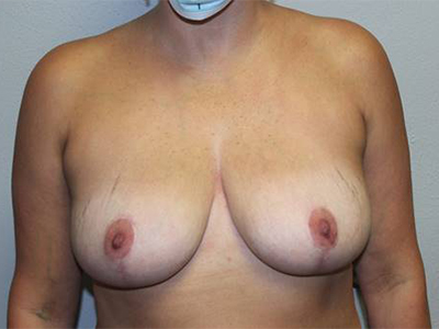 Breast Explant