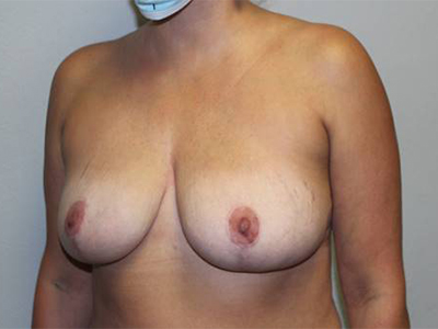 Before & After Photos Breast Explant