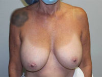 Before & After Photos: Breast Explant with Lift or Reduction