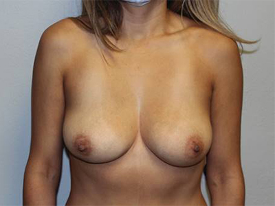 Breast Explant