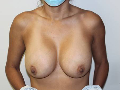 Breast Explant