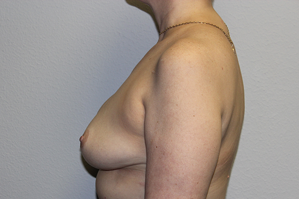 Before and after plastic surgery results in Dallas, TX, performed by Dr. Surjit Rai, MD.
