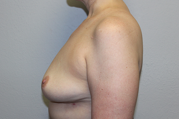 Before and after plastic surgery results in Dallas, TX, performed by Dr. Surjit Rai, MD.