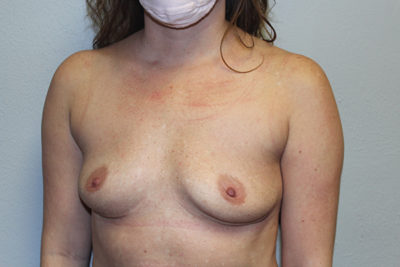 Breast Explant