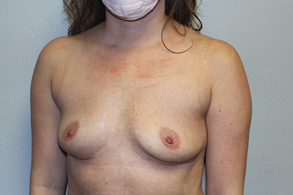 Before and after plastic surgery results in Dallas, TX, performed by Dr. Surjit Rai, MD.