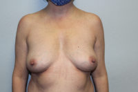 Breast Explant